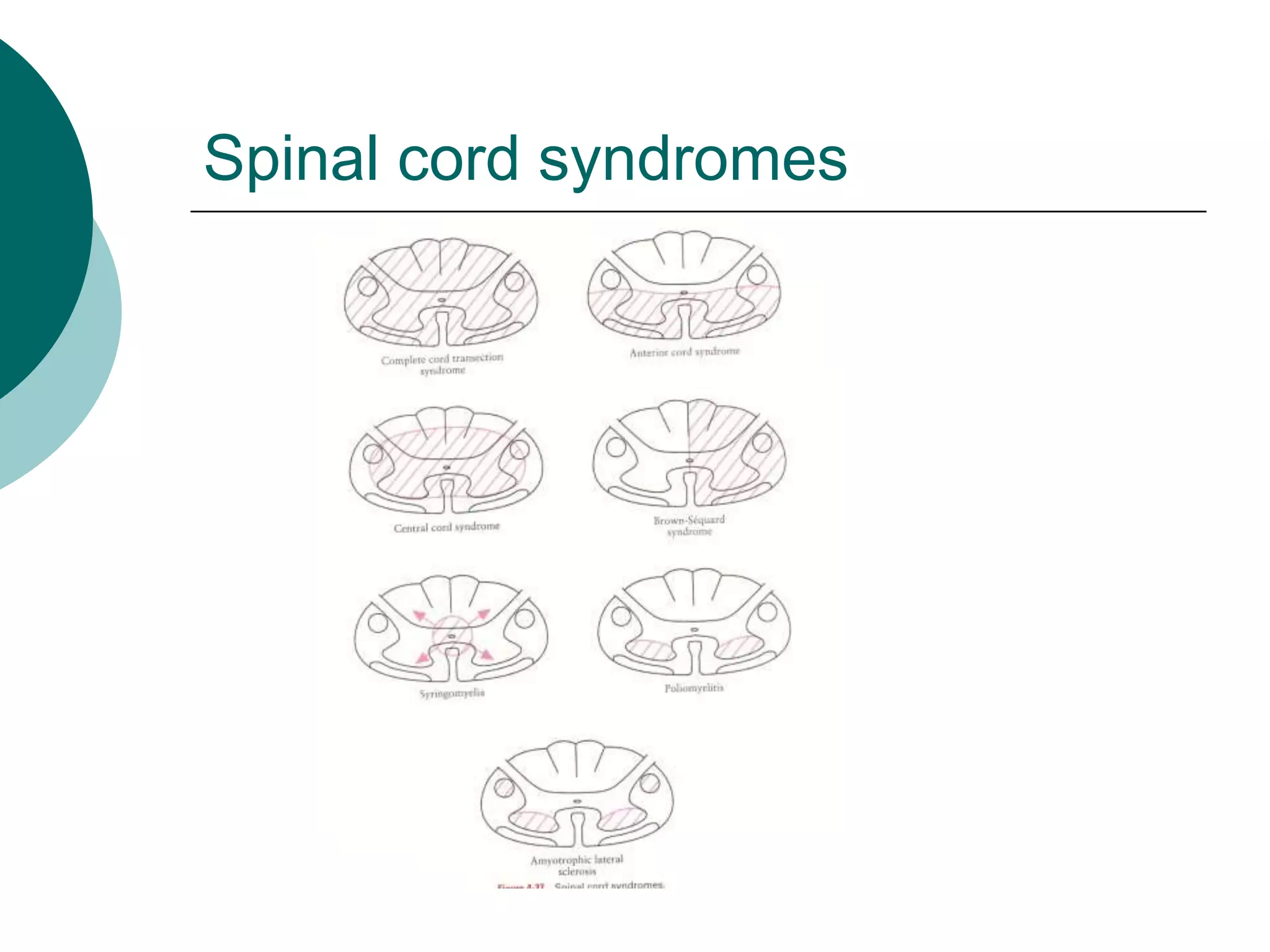 Spinal cord syndromes
 