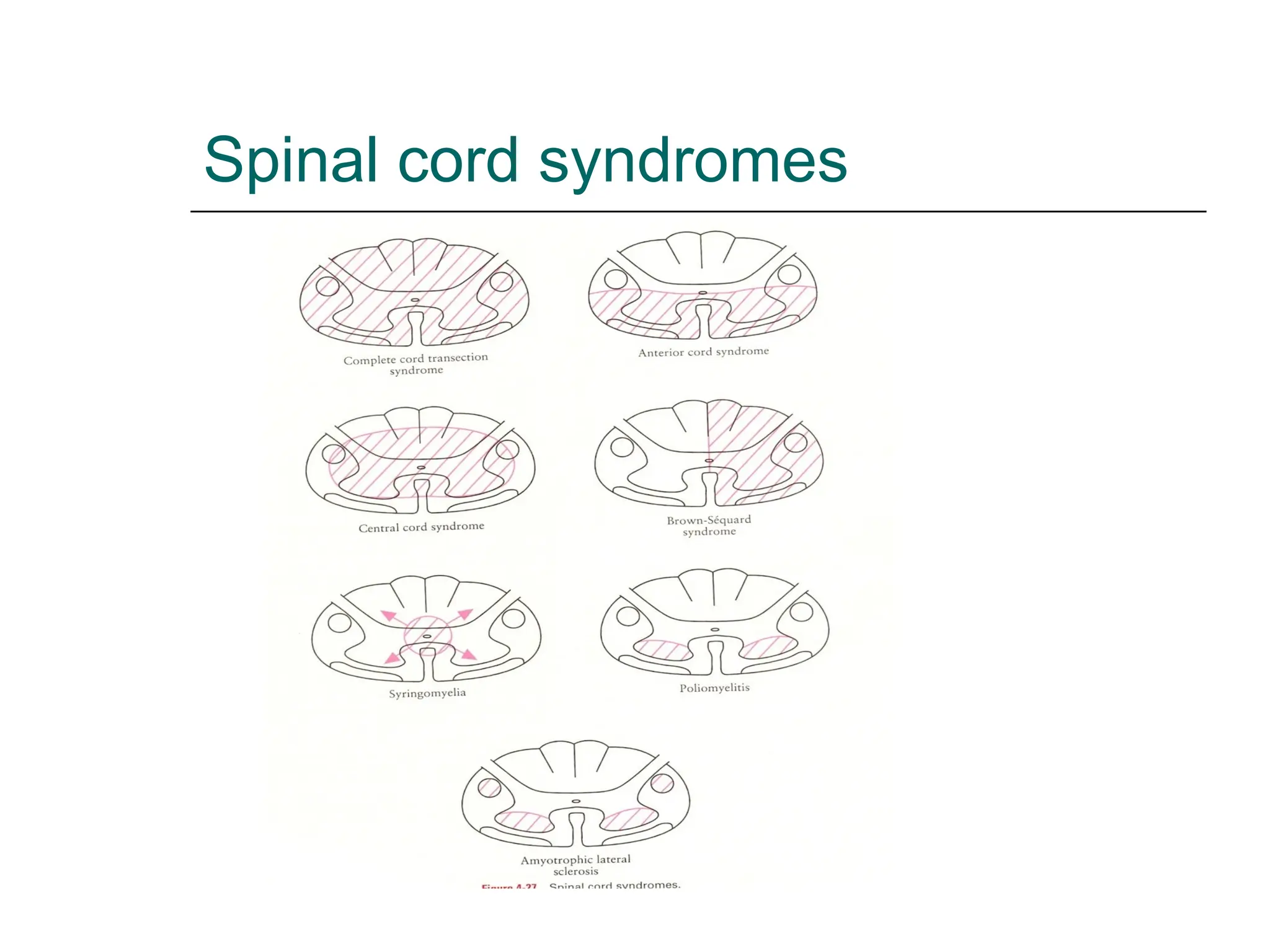 Spinal cord syndromes
 