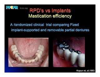 1.(new)introduction and basic components of rpd's | PDF