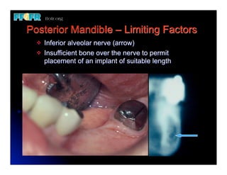 Rpd Inferior 1.(new)introduction and basic components of rpd's | PDF