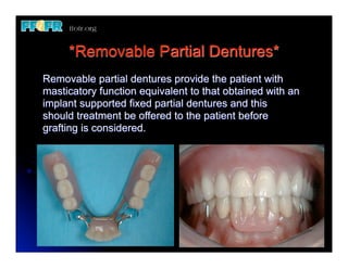1.(new)introduction and basic components of rpd's | PDF