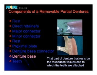 1.(new)introduction and basic components of rpd's | PDF