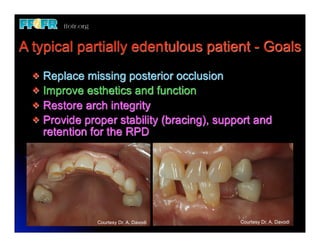 1.(new)introduction and basic components of rpd's | PDF