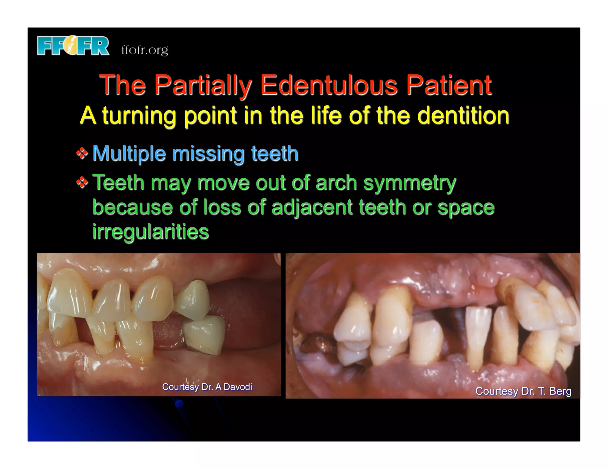 1.(new)introduction and basic components of rpd's | PDF | Dental Health ...