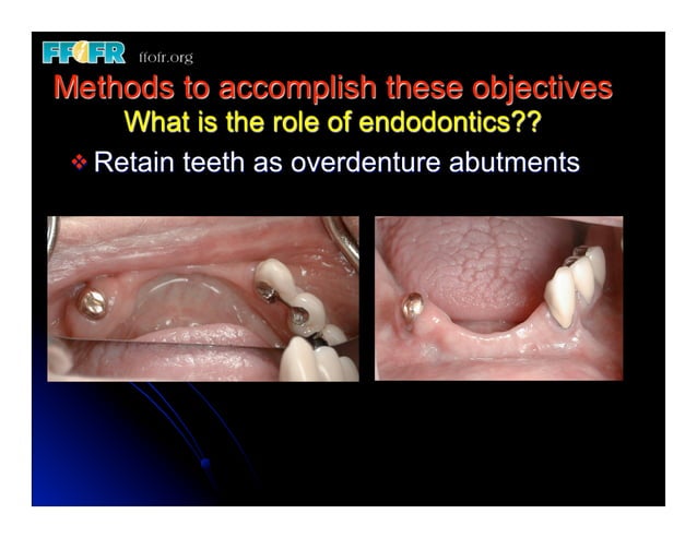 1.(new)introduction and basic components of rpd's | PDF | Dental Health ...