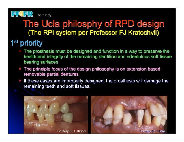 1.(new)introduction and basic components of rpd's | PDF | Dental Health ...