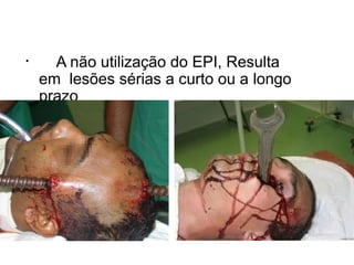 • A não utilização do EPI, Resulta
em lesões sérias a curto ou a longo
prazo
 