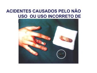 ACIDENTES CAUSADOS PELO NÃO
USO OU USO INCORRETO DE
EPIs
 