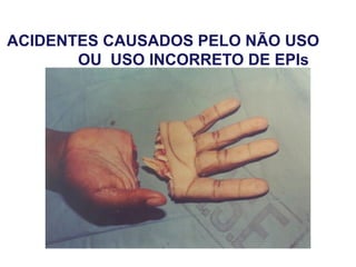ACIDENTES CAUSADOS PELO NÃO USO
OU USO INCORRETO DE EPIs
 