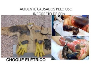 CHOQUE ELÉTRICO
ACIDENTE CAUSADOS PELO USO
INCORRETO DE EPIs
 