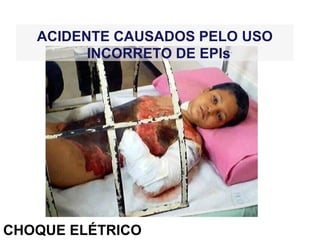 CHOQUE ELÉTRICO
ACIDENTE CAUSADOS PELO USO
INCORRETO DE EPIs
 