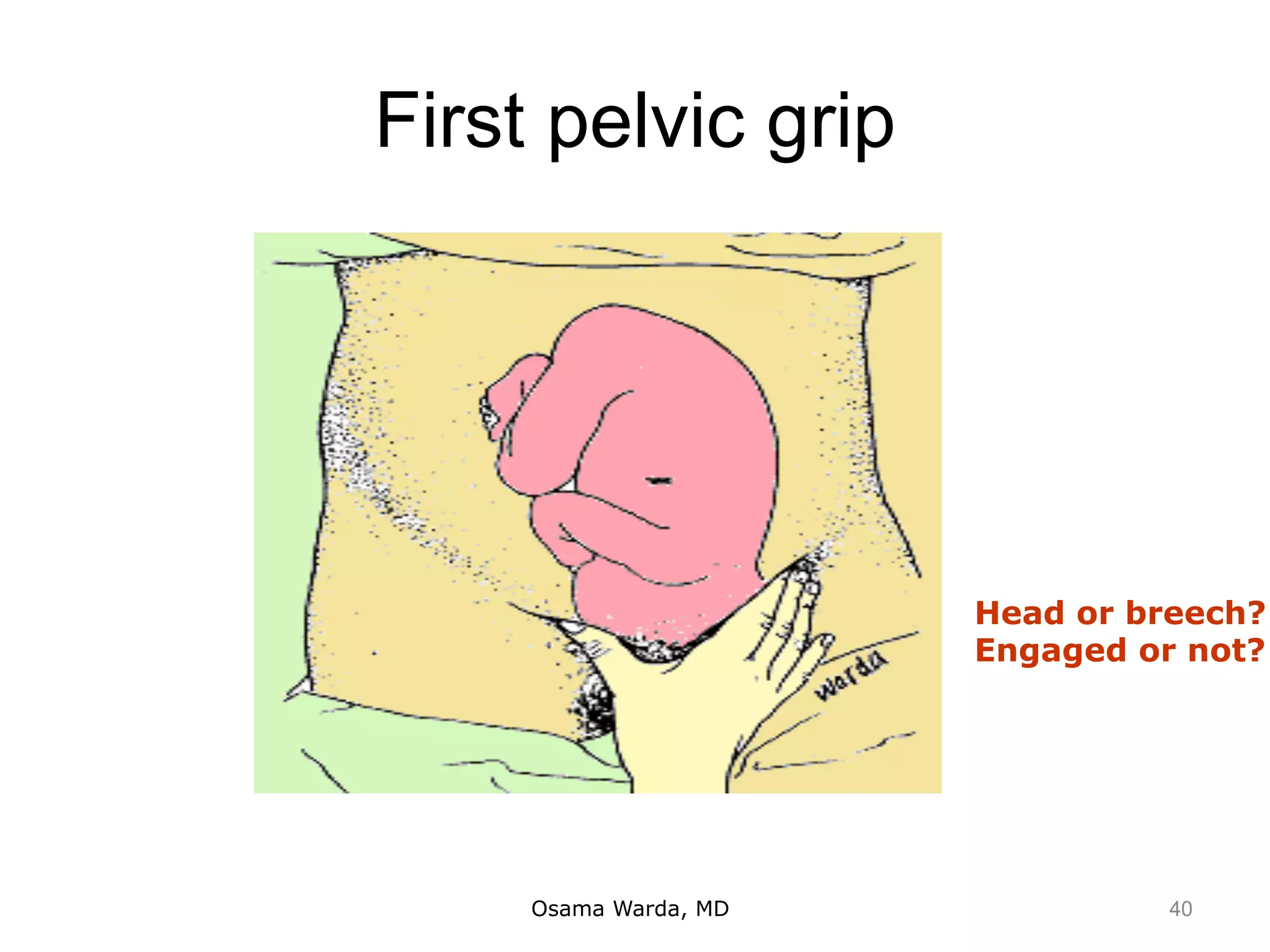 First pelvic grip
Osama Warda, MD
Head or breech?
Engaged or not?
40
 
