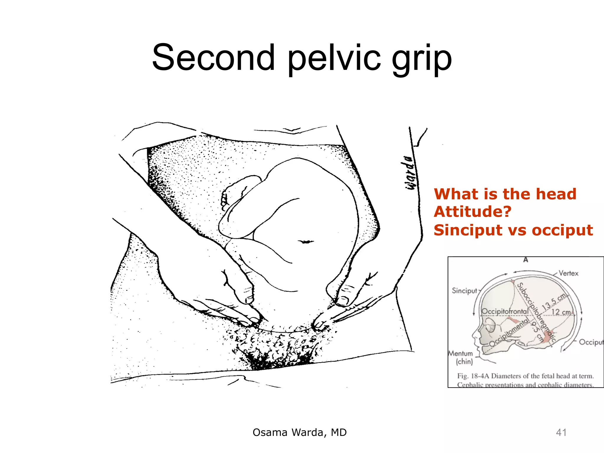 Second pelvic grip
Osama Warda, MD
What is the head
Attitude?
Sinciput vs occiput
41
 