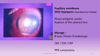 Ophthalmology OSCE | PDF