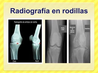 Radiografía en rodillas
 