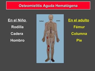 En el Niño
Rodilla
Cadera
Hombro
En el adulto
Fémur
Columna
Pie
Osteomielitis Aguda HematógenaOsteomielitis Aguda Hematógena
 