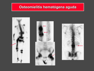 Osteomielitis hematógena agudaOsteomielitis hematógena aguda
 