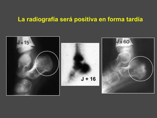 La radiografía será positiva en forma tardía
J + 16
 