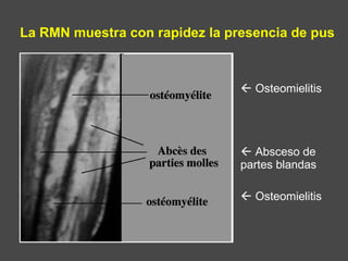 La RMN muestra con rapidez la presencia de pus
 Osteomielitis
 Absceso de
partes blandas
 Osteomielitis
 