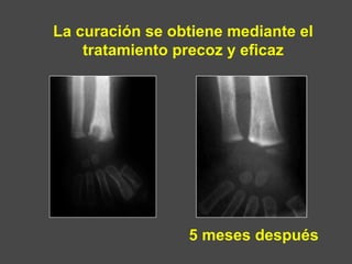 La curación se obtiene mediante el
tratamiento precoz y eficaz
5 meses después
 