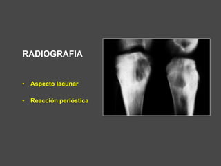 RADIOGRAFIA
• Aspecto lacunar
• Reacción perióstica
 