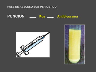 FASE DE ABSCESO SUB-PERIOSTICOFASE DE ABSCESO SUB-PERIOSTICO
PUNCION Pus Antibiograma
 