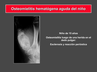 Niño de 15 años
Osteomielitis luego de una herida en el
dedo pulgar:
Esclerosis y reacción perióstica
Osteomielitis hematógena aguda del niñoOsteomielitis hematógena aguda del niño
 