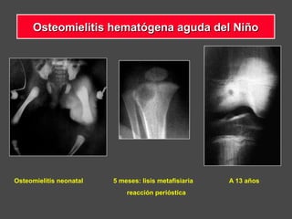 Osteomielitis neonatal 5 meses: lisis metafisiaria A 13 años
reacción perióstica
Osteomielitis hematógena aguda del NiñoOsteomielitis hematógena aguda del Niño
 