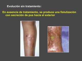En ausencia de tratamiento, se produce una fistulización
con secreción de pus hacia el exterior
Evolución sin tratamiento:
 