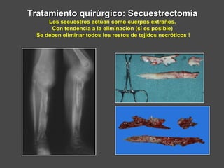 Tratamiento quirúrgico: SecuestrectomíaTratamiento quirúrgico: Secuestrectomía
Los secuestros actúan como cuerpos extraños.
Con tendencia a la eliminación (si es posible)
Se deben eliminar todos los restos de tejidos necróticos !
 