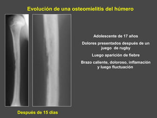Evolución de una osteomielitis del húmero
Adolescente de 17 años
Dolores presentados después de un
juego de rugby
Luego aparición de fiebre
Brazo caliente, doloroso, inflamación
y luego fluctuación
Después de 15 días
 