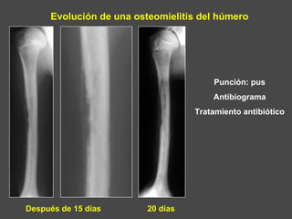 Evolución de una osteomielitis del húmero
Punción: pus
Antibiograma
Tratamiento antibiótico
Después de 15 días 20 días
 