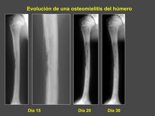 Evolución de una osteomielitis del húmero
Día 15 Día 20 Día 30
 