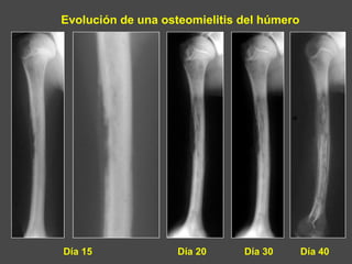 Evolución de una osteomielitis del húmero
Día 15 Día 20 Día 30 Día 40
 