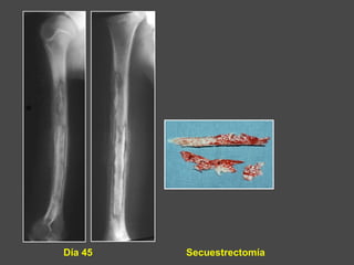 Día 45 Secuestrectomía
 