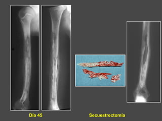 Día 45 Secuestrectomía
 