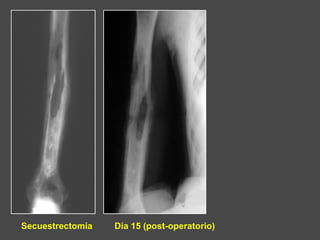 Secuestrectomía Día 15 (post-operatorio)
 