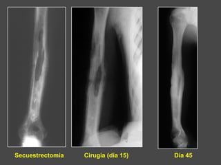 Secuestrectomía Cirugía (día 15) Día 45
 