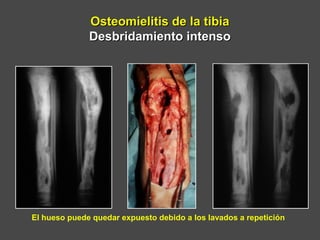 Osteomielitis de la tibiaOsteomielitis de la tibia
Desbridamiento intensoDesbridamiento intenso
El hueso puede quedar expuesto debido a los lavados a repetición
 