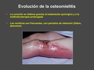 • La curación se obtiene gracias al tratamiento quirúrgico y a la
antibioticoterapia prolongada
• Las recidivas son frecuentes, con periodos de retención (fiebre,
abscesos)
Evolución de la osteomielitis
 