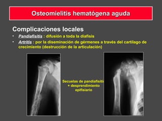 Complicaciones locales
• Pandiafisitis : difusión a toda la diafisis
• Artritis : por la diseminación de gérmenes a través del cartílago de
crecimiento (destrucción de la articulación)
Secuelas de pandiafisitis
+ desprendimiento
epifisiario
Osteomielitis hematógena agudaOsteomielitis hematógena aguda
 
