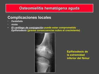 Complicaciones locales
• Pandiafisitis
• Artritis
• El cartílago de conjugación puede estar comprometido
Epifisiodesis (graves consecuencias sobre el crecimiento)
Epifisiodesis de
la extremidad
inferior del fémur
Osteomielitis hematógena agudaOsteomielitis hematógena aguda
 