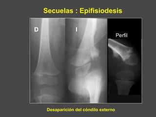 Secuelas : Epifisiodesis
Desaparición del cóndilo externo
D I
Perfil
 