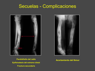 Secuelas - Complicaciones
Pandiafisitis del radio
Epifisiodesis del extremo distal
Fractura secundaria
Acortamiento del fémur
 