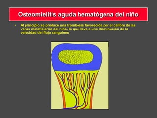 • Al principio se produce una trombosis favorecida por el calibre de las
venas metafisiarias del niño, lo que lleva a una disminución de la
velocidad del flujo sanguíneo
Osteomielitis aguda hematógena del niñoOsteomielitis aguda hematógena del niño
 