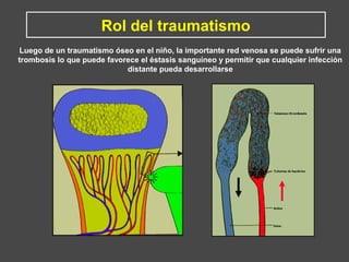 Luego de un traumatismo óseo en el niño, la importante red venosa se puede sufrir una
trombosis lo que puede favorece el éstasis sanguíneo y permitir que cualquier infección
distante pueda desarrollarse
Rol del traumatismo
 