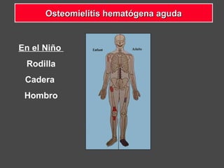 En el Niño
Rodilla
Cadera
Hombro
Osteomielitis hematógena agudaOsteomielitis hematógena aguda
 