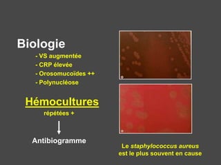Le staphylococcus aureus
est le plus souvent en cause
Biologie
- VS augmentée
- CRP élevée
- Orosomucoïdes ++
- Polynucléose
Hémocultures
répétées +
Antibiogramme
 