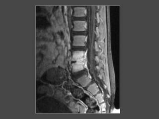 Ostéomyélite vertébrale
Destruction complète du disque et partielle des 2 corps vertébraux
 