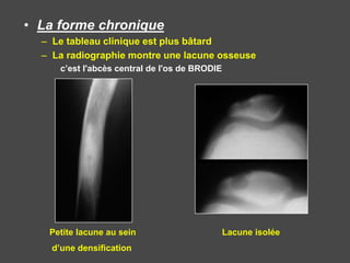 • La forme chronique
– Le tableau clinique est plus bâtard
– La radiographie montre une lacune osseuse
c’est l'abcès central de l'os de BRODIE
Petite lacune au sein Lacune isolée
d’une densification
 